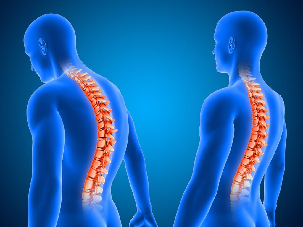 3D medical background showing correct and poor posture with spin